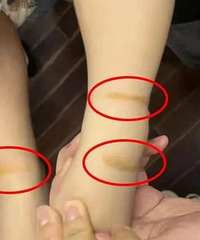 ̨��2��С���ѳ��֣������������Ҫ���裡ҽ������ֻ�Ǵ��˻��