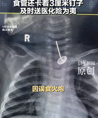 10�´�Ӥ����ʳ�����¿�ǻ��ը�ˣ�ʳ�ܻ�����3���׶���