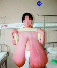 "泌乳素失调 女子被43斤巨乳所累举步维艰"