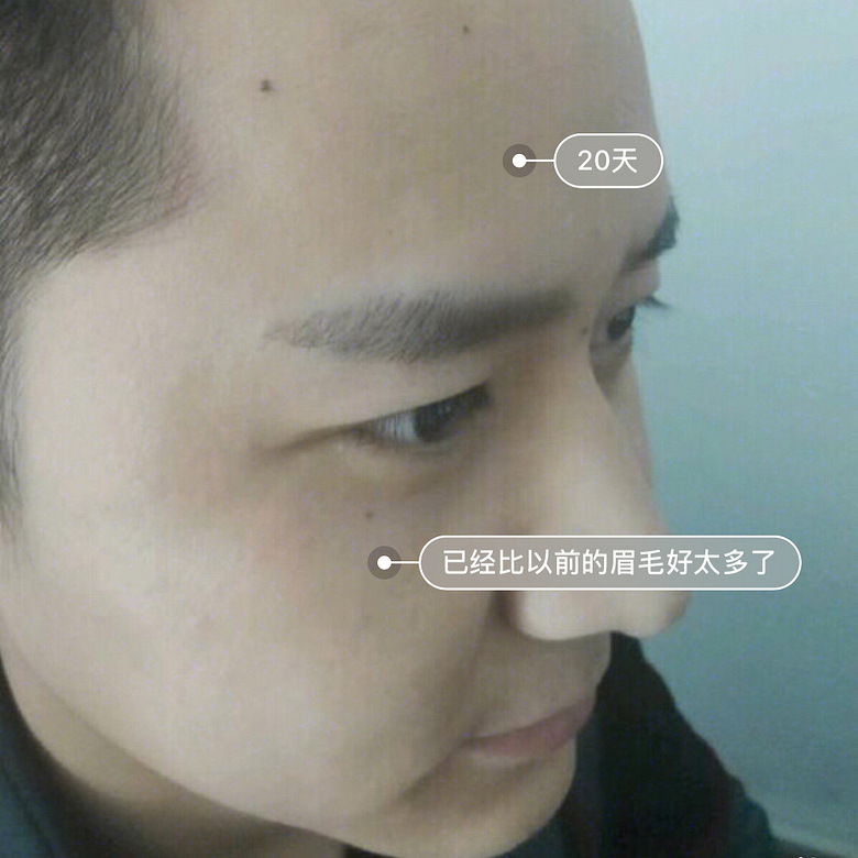 我是做销售工作的需要经常出差谈客户,我眉毛天生只有半截