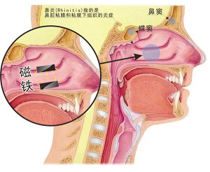 两块磁铁在鼻孔里整整呆了8年 小学二年级时塞进去的昨天刚取出来