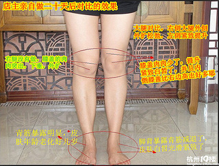 左右腿粗细不一样,是不起细点的那条腿萎缩了