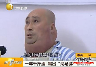 长期酗酒患怪病"河马脖" 决心一定戒掉酒