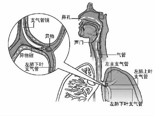 咳嗽不止竟是因为一颗小黄豆堵住大伯左肺支气管