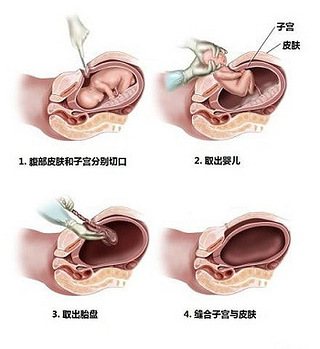 剖宫产前注意事项