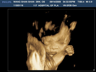 三维b超能看出胎记吗?宝宝脸上有阴影,担心中,大家帮忙看看?
