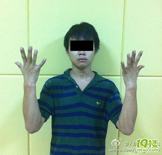 右手拇指被菜刀切入,伤口还血淋淋的(图)