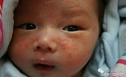 宝宝的急疹、湿疹、风疹、水痘、幼儿各种疹子
