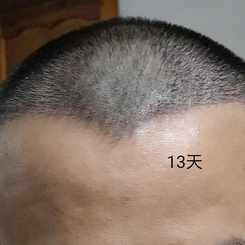 杭州科发源植发