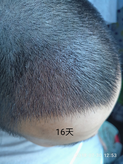 杭州科发源植发