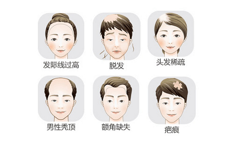 昆明靠谱的植发医院排名