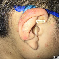 ����ʪ�����أ�������Ϊʹ�ü���ҩ�࣬��ë���д��˵ĳ���