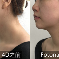Ӵ̽ʹ濹˥Fotona 4D沿