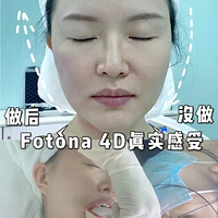 35С̵һνӴ˥fotona 4D