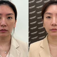 痘肌，敏感肌都能做的抗衰黄金微针，缩毛孔，改善肤质，还能抗老