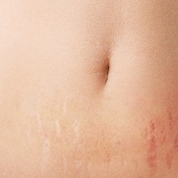 ����̺ۣ������ƣ����� ��ACNOPlasma���ӵ�����������