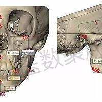 ���ֻ���������ڹؽ�ǿֱ�������е�Ӧ��