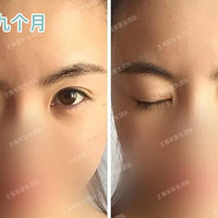 ���������Σ�˫��Ƥ�İ̺ۺô��������۽ǵİ̺ۿ�զ��