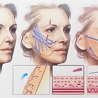 �ߵ���ʲô���ߵ�ٷ�֮��ʮ������ߵ����֢��ô��ܣ�