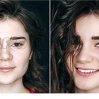 ���ڵ�ʲô��ŷ��֮��fotona4dpro����~