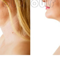 ŷ��֮��fotona�ۼۡ�������֪���Ķ�������~