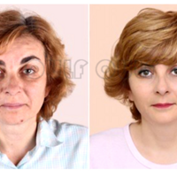 fotona 4d��ʲô���ö��˶������~