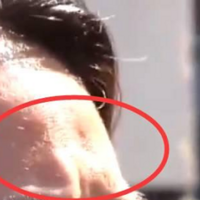 ǧ�����֬������沿�����˽�ȫ��֬��������֢����~