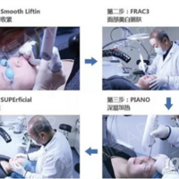 fontona 4dŷ��֮�ǡ�ŷ��֮��fotona4dpro�Ĺ�Ч