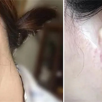 ��Ƥ�����ķ��պͺ���֢����Ƥ����֢����Щ