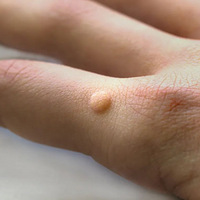 ���裡�۾���Χ����С����ǧ��𼷣�С����HPV�������