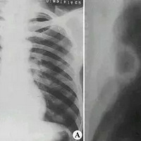 �������鵽ȷ����ײ���72Сʱ�����ݱ��裺���ӵ��������һ��