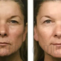 ȫ����Ƥ������ά�ּ��ꡢ��Ƥһ�����ά�ֶ��