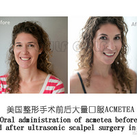 �����󡢳����ڶ�Ƥ�����˺�����Щ��Ϊʲô���곬���ڱ����~