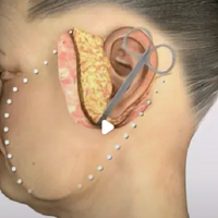 ���˽�Ĥ��������������͹��ƽ�������Ĥ������ûָ�