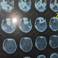 ҽ��ĥ��ͷĥ���������ҵ�ͷ�Ǳ��滻���˽�����