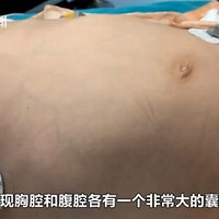 4岁娃腹中抽出2斤寄生虫液！屁股痒、肚痛，要当心！