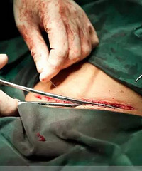 "剖腹产全过程照片,男士们有勇气看完吗?(四)"