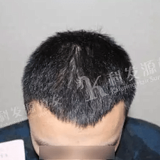 武汉靠谱植发医院