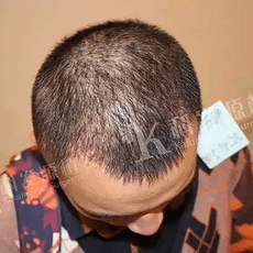 武汉靠谱植发医院