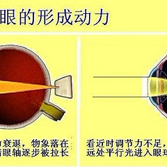 近视形成的原因