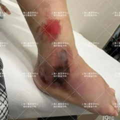 6岁女童这个部位肿成“馒头”，有脓液渗出！家长拖了3天