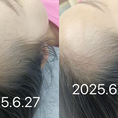 今天太开心了，为一个美女治疗头发，才一周时间已经有明显的效果