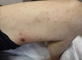 ����40�棡���ݶ��˱���ҧ�ˣ�֢״�����ð�����ؿ�����