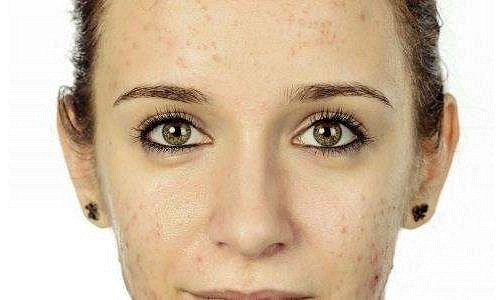 西安画美医疗美容医院-西安对于油性皮肤如何控油