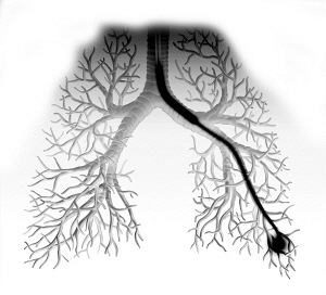 有个单位10%的人查出肺部结节 它与肺癌到底有什么关系?