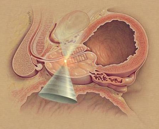 结扎对男性的影响