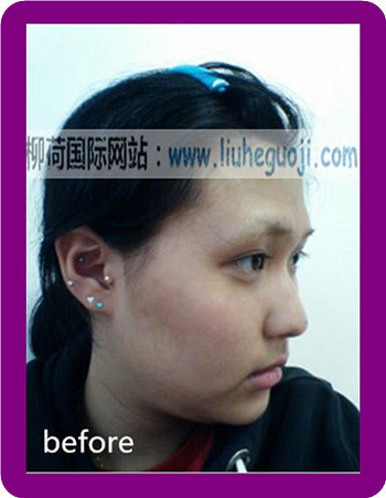 割双眼皮失败去哪里修复好