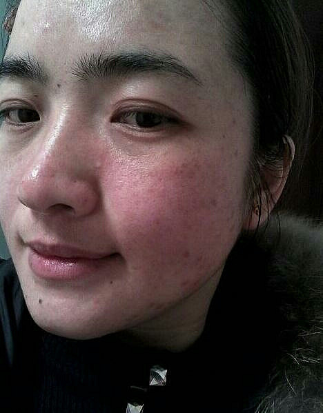 不要等到痘痘严重了再来,从悲伤走向自信