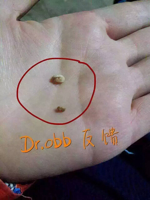 这漱口水真强,用了几天牙结石就掉了。