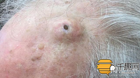 超恶!医生挤出十年大黑头,拔出瞬间高潮了!